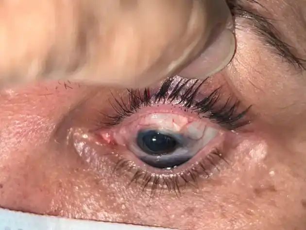 eye picture taken through a phone